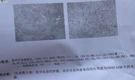 我妈妈宫颈癌肝脏转移smarca4缺失的未分化癌