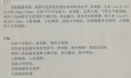 肺鳞癌单药维持1年，出现脑转，放疗后，还是单药维持的....或是消融。