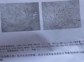 我妈妈宫颈癌肝脏转移smarca4缺失的未分化癌